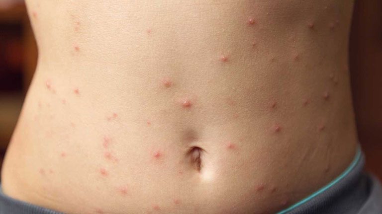 Nguyên nhân và cách phòng tránh triệu chứng nổi mụn nước không ngứa