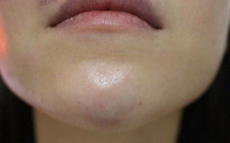 Tiêm filler cằm bị tím phải làm sao? Cần lưu ý điều gì sau khi tiêm filler cằm?